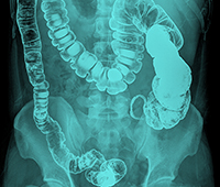 Gastric tumor Symptoms